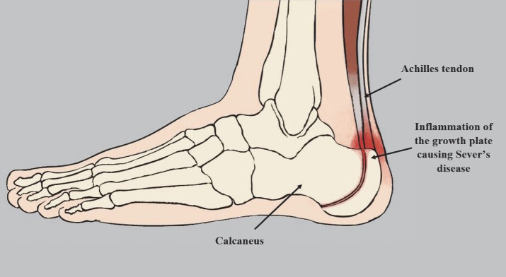 severs disease